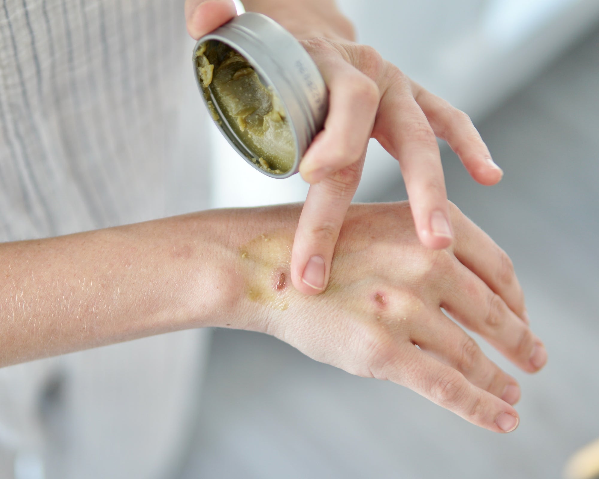How to use Rescue Balm (How to Naturally Heal Irritated, Dry Skin)